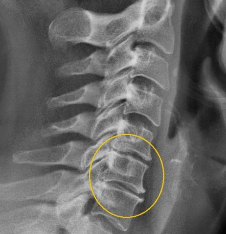 ostéochondrose cervicale